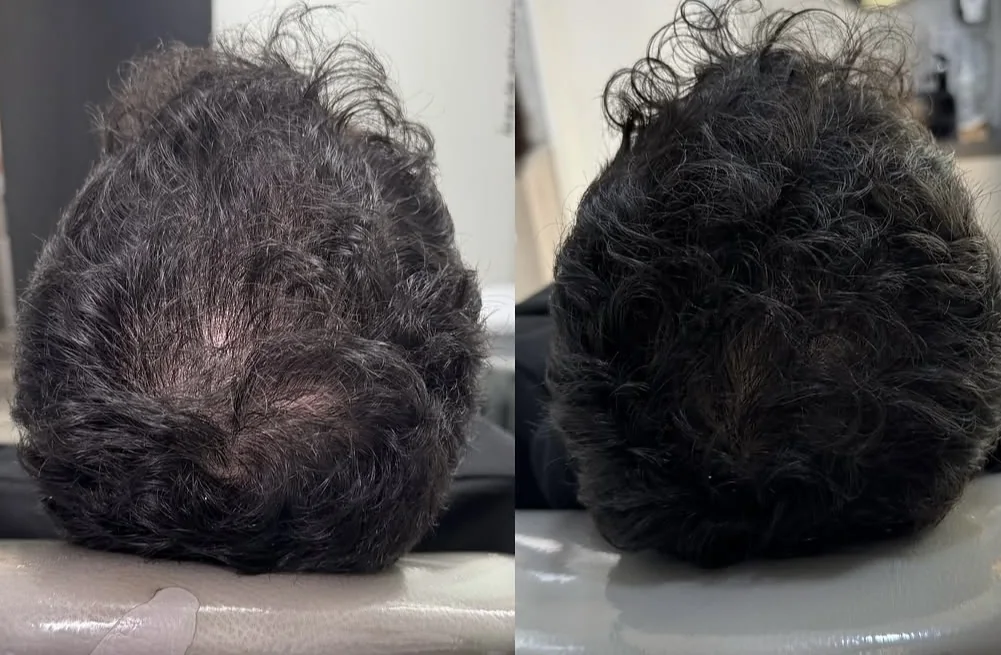 Registro comparativo do topo do couro cabeludo, antes e depois do período de acompanhamento